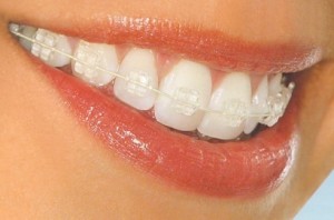 vasteland Kosciuszko Met andere woorden Orthodontie Den Haag | Orthodontist